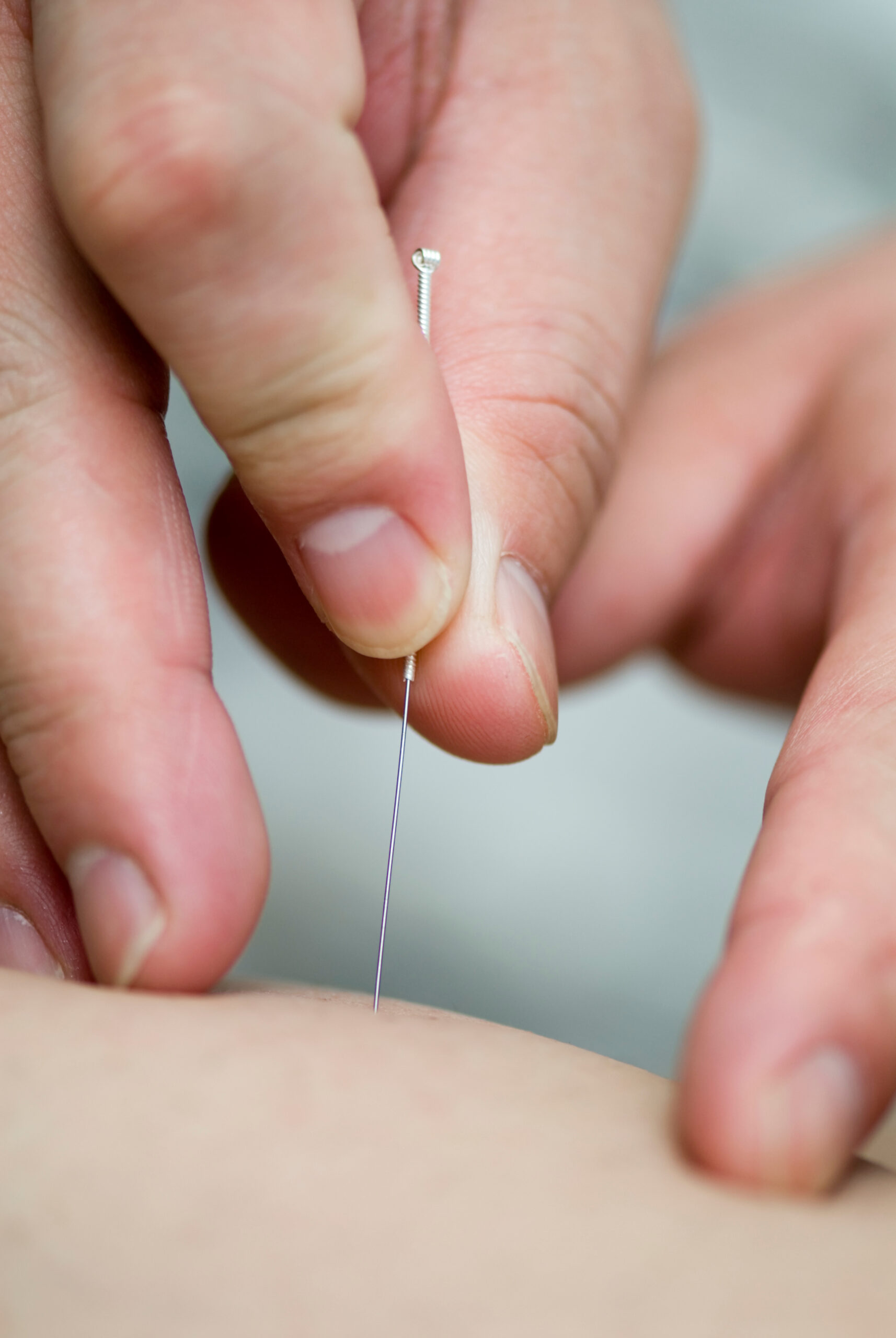Acupuncture treatment at Wilke Chiropractic